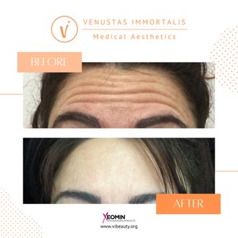 Venustas Immortalis - Botox Injections - Med Spa in Janesville, WI - Skin Care Near Me - Milton , Wisconsin Venustas Immortalis - Botox Injections - Med Spa in Janesville, WI - Skin Care Near Me - Milton , Wisconsin