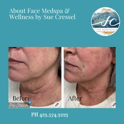 About Face Medspa & Wellness - Facial refrigeration and profile balancing are common advanced procedures performed by Sue Cressel, Master Injector.