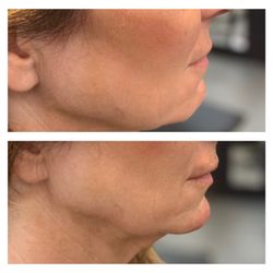 Lake Tapps Beauty Bar & Wellness - Jawline enhanced (after above- before below)