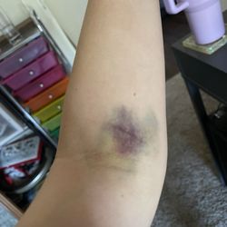 Quest Diagnostics - Nasty hematoma. This was a week after the blood draw.