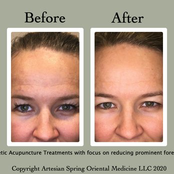 Fox Haven Aesthetics - Acupuncture Near Me - Windsor, Colorado Fox Haven Aesthetics - Acupuncture Near Me - Windsor, Colorado