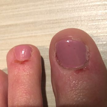 Zen Nail Spa - Bloody cuticles - Nail Salons Near Me - Orange, Ohio