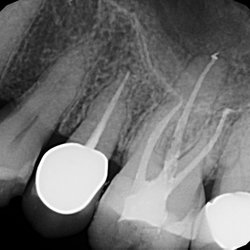 Riverdale Dental, PC - Root Canal or Endodontic treatment doesn't have to be painful.