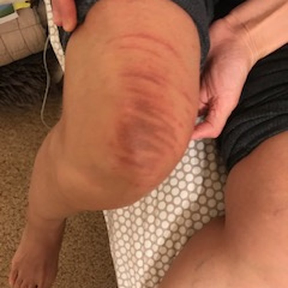 Cryo Wellness - This is day 2 after the injury. - Undersea/Hyperbaric Medicine Near Me - Austin, Texas Cryo Wellness - This is day 2 after the injury. - Undersea/Hyperbaric Medicine Near Me - Austin, Texas