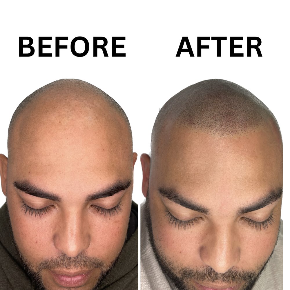 SCALP MICRO KANSAS CITY Request an Appointment Wesley Chapel, Florida Hair Loss Centers