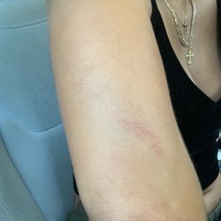 Gainesville Police Department - Bruises caused by violent bouncer