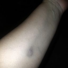 a person's arm with a black spot on it