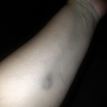 Eighty Sixed Sports Lounge - a person's arm with a black spot on it - Dive Bars Near Me - Ontario, California