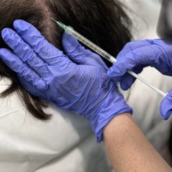 Aesthetics Health & Wellness - Hair PRP-Platelet Rich Plasma.