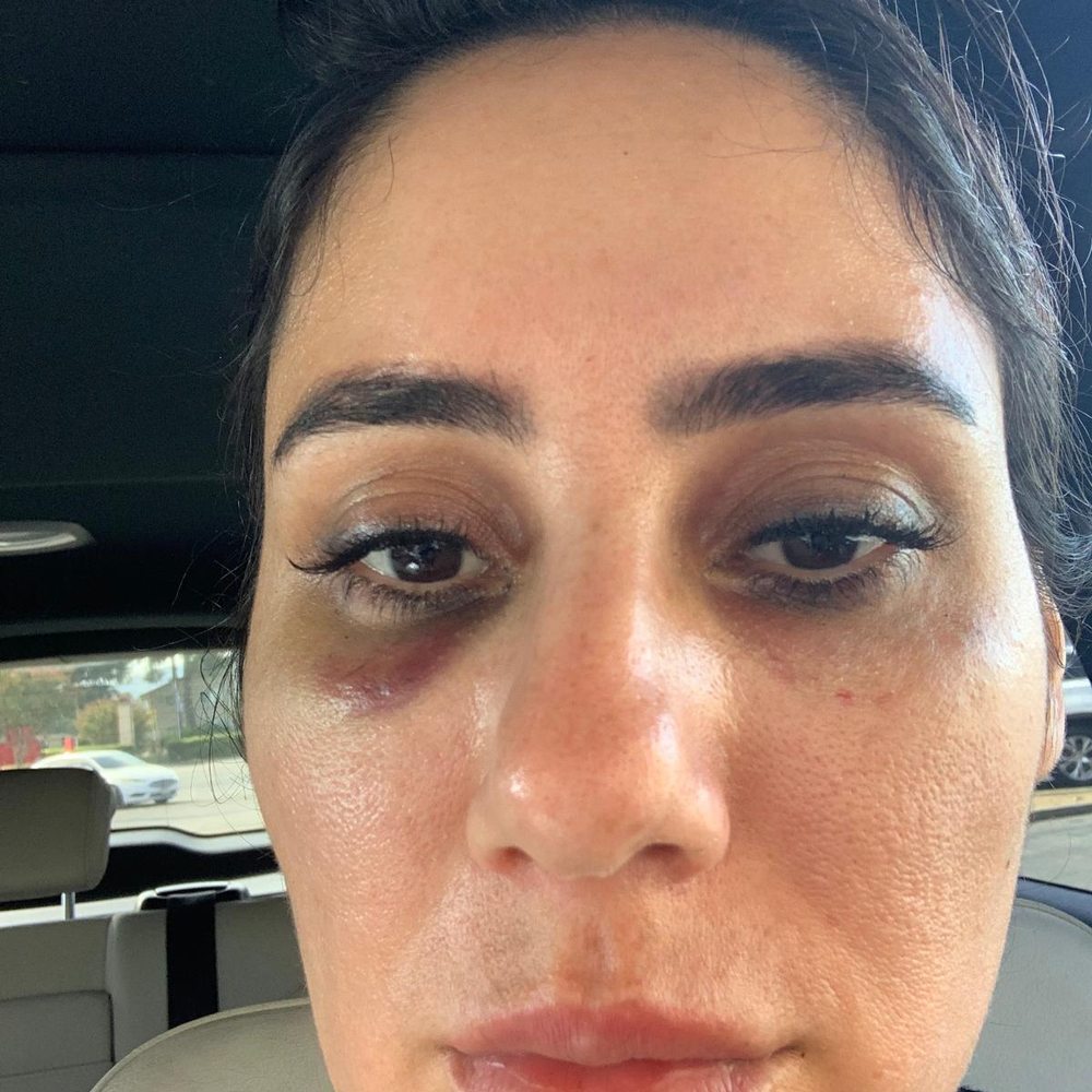 Steven K Struck, MD - Telling me is normal the black eye he gave me doing a eye filler - Cosmetic Surgeons Near Me - Atherton, California Steven K Struck, MD - Telling me is normal the black eye he gave me doing a eye filler - Cosmetic Surgeons Near Me - Atherton, California