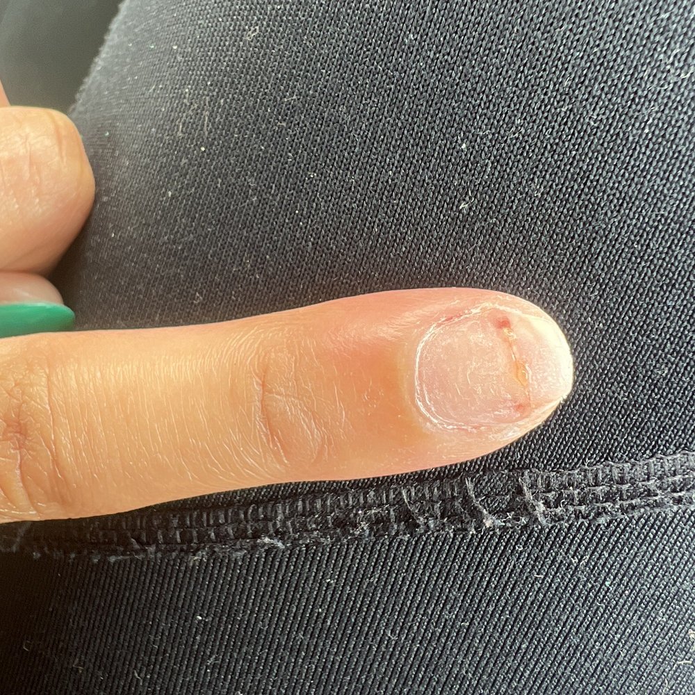 Vinci Nail Spa - Infected nail - Nail Salons Near Me - High Point, North Carolina Vinci Nail Spa - Infected nail - Nail Salons Near Me - High Point, North Carolina