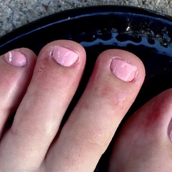 Nature Nails And Spa - Cuts on the far right three toes below and next to the nail - Nail Salons Near Me - Scottsdale, Arizona Nature Nails And Spa - Cuts on the far right three toes below and next to the nail - Nail Salons Near Me - Scottsdale, Arizona