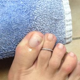 The gouge in my big toe after he scraped off the gel instead of using acetone and foil.