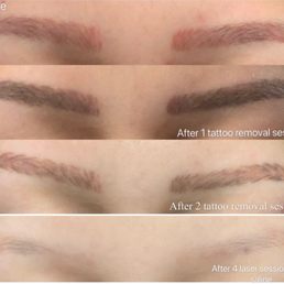 Microblading removal progress 4 laser & 1 normal saline - still red and healing 2 months after saline removal