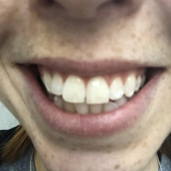 Carnegie Dental Wellness - After!!!! (FYI This is not bleaching, I have done that before and it didnt work for me.) - Cosmetic Dentists Near Me - New York, New York
