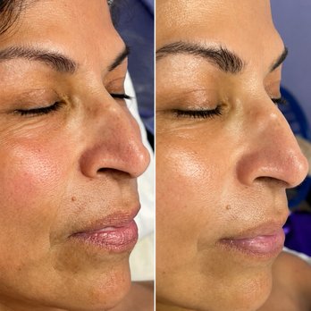 Sky Beauty Studio - Real before & after results from a customized facial. Deep cleansing, exfoliation, hydration, and pore care helped improve the skin's textur - Estheticians Near Me - Ontario, California Sky Beauty Studio - Real before & after results from a customized facial. Deep cleansing, exfoliation, hydration, and pore care helped improve the skin's textur - Estheticians Near Me - Ontario, California