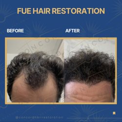 Concord Hair Restoration