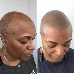 The Bar Aesthetics - Scalp Micropigmentation Alopecia