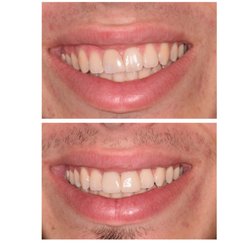 Handsome Young Man wanted white straight front teeth.