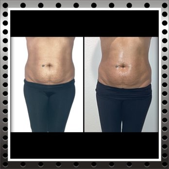 Body By Tye - Ultrasound Cavitation
4 Sessions Recommended - Body Contouring Near Me Body By Tye - Ultrasound Cavitation
4 Sessions Recommended - Body Contouring Near Me