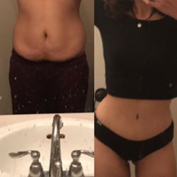 Salutaris Medical Center - Pre and post tummy tuck!