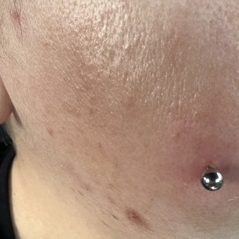 The Piercing Shop - Red ring around the piercing 19 mm barbell and I am pushing it out - Piercing Near Me - Orange, California The Piercing Shop - Red ring around the piercing 19 mm barbell and I am pushing it out - Piercing Near Me - Orange, California