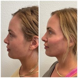 Elan Vital Medical Aesthetics - Cheek filler