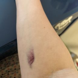 Bruising on my arm 24 hrs after blood draw.