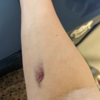 Labcorp - Bruising on my arm 24 hrs after blood draw. - Laboratory Testing Near Me - Oxon Hill, Maryland