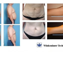 Crystal Lume Medical Spa - Ultrasound cavitation treatment, one inch same day ( fat and Cellulite) $500