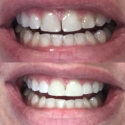Mermilliod David W, DDS - Before and after upper anterior bonding. Excellent Dentist, wonderful staff. Highly recommended
