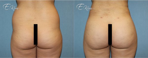 Brazilian Butt Lift (BBL) - Brazilian Butt Lift (BBL) surgery (also referred to as Brazilian Butt Augmentation) is performed to augment the size and projection of the buttocks, while enhancing the contours and overall proportions of the patient’s backside. Brazilian Butt Lift (BBL) - Brazilian Butt Lift (BBL) surgery (also referred to as Brazilian Butt Augmentation) is performed to augment the size and projection of the buttocks, while enhancing the contours and overall proportions of the patient’s backside.