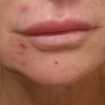 Charles S. Lee, MD - Jawline with fillers after 3 days - Cosmetic Surgeons Near Me - Beverly Hills, California Charles S. Lee, MD - Jawline with fillers after 3 days - Cosmetic Surgeons Near Me - Beverly Hills, California