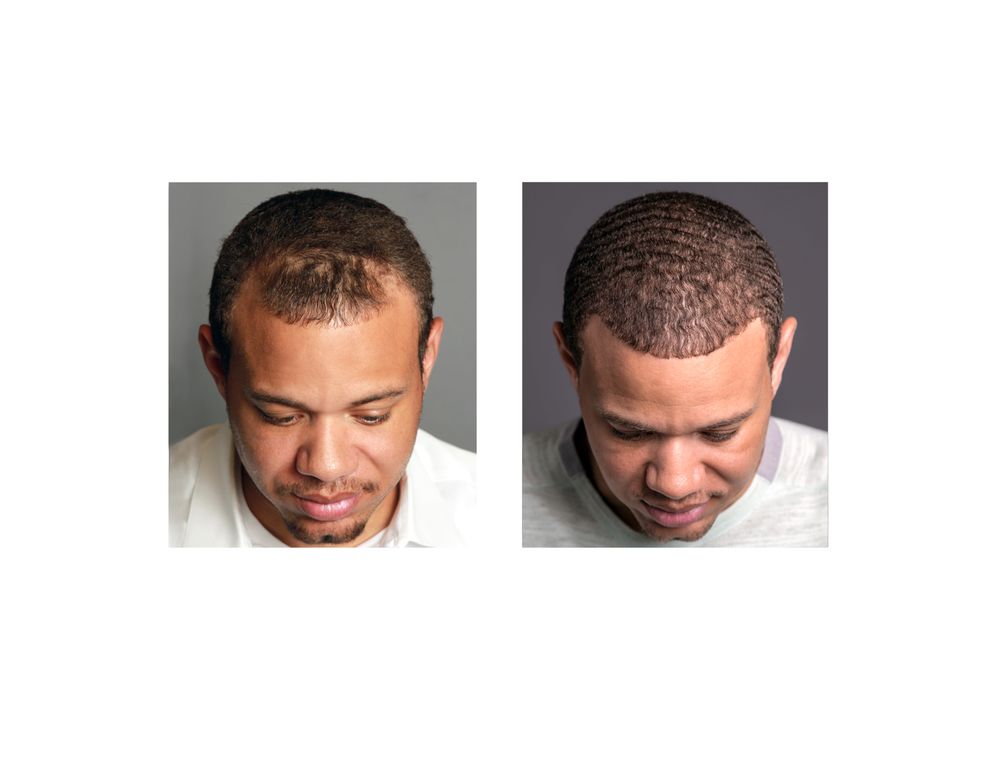Bosley Hair Transplant & Restoration Logo