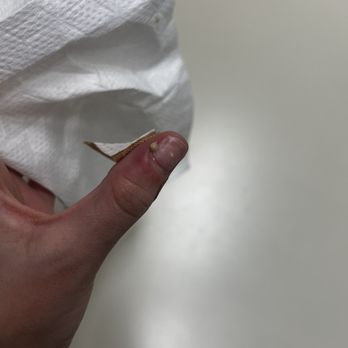COCO Nail Bar - infected nail - A photograph shows a person's finger with an infected, swollen nail that has pus visible underneath. The finger appears red and inflamed, indicating infection. The person is holding the finger over a plain, light-colored surface, with a tissue nearby. The image focuses on the affected nail and surrounding skin, highlighting signs of infection. - Nail Salons Near Me - Algonquin, Illinois
