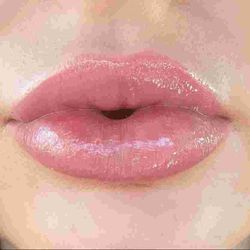 Using one syringe of Restylane Kysse in lips