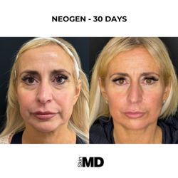 SkinMD Peabody - NeoGen. The ultimate in skin rejuvenation and skin tightening!