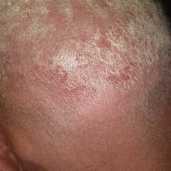 Beauty Concepts - Chemical burn left rear. - Hair Stylists Near Me - Woodland, California Beauty Concepts - Chemical burn left rear. - Hair Stylists Near Me - Woodland, California