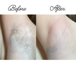 It's Only Skin Deep - Have you been Sugared? Natural Hair Removal that removes unwanted hair on any part of the body!
