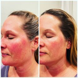Pink Daisy Beauty Bar - Customized skin rejuvenation facial helped calm this client's redness