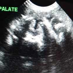 Ultrasound Imaging Options - Cleft palate can sometimes be identified on ultrasound in utero.