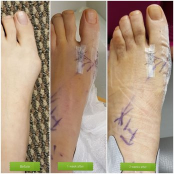 Robert Joseph, DPM - Like I said Yelpers, I was blown away by the results! I'm so happy! Thank you Dr. Robert Joseph! - Podiatrists Near Me - Beverly Hills, California