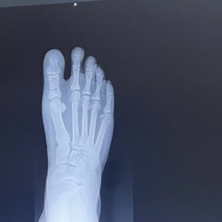 Cd'a Foot and Ankle Clinic - Say hello to my right foot.  Almost four weeks post op.