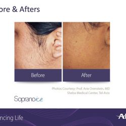 Kayakalp Wellness Spa - Kayakalp Soprano ICE Laser hair removal before and after