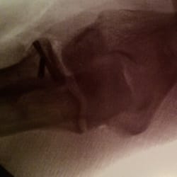 Southern Orthopedic Specialists P A - Couple of pins and it's back together. Thanks Dr. Kellum!