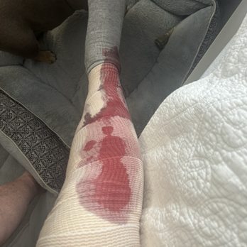 The CORE Institute - North Phoenix - Bleeding after following the PT instructions. This is approximately 7 hours after surgery, and followed 3 hours of at-home PT prescribed - Orthopedists Near Me - Phoenix, Arizona The CORE Institute - North Phoenix - Bleeding after following the PT instructions. This is approximately 7 hours after surgery, and followed 3 hours of at-home PT prescribed - Orthopedists Near Me - Phoenix, Arizona