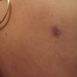 3 weeks after facial with extraction with some treatment to lighten the scar.