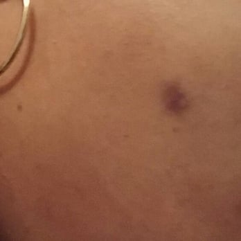 Tones Day Spa - 3 weeks after facial with extraction with some treatment to lighten the scar. - Hair Removal Near Me - The Bronx, New York
