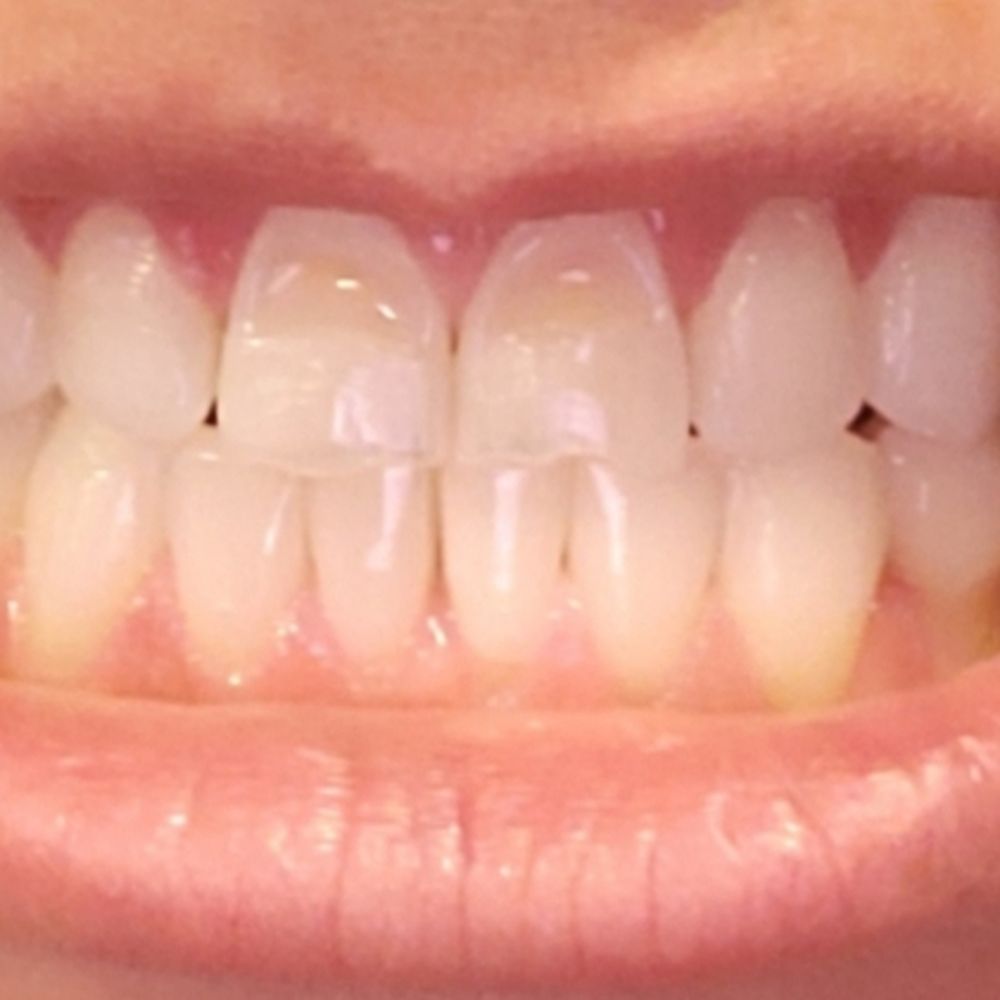 Glendora Dental - Before - Cosmetic Dentists Near Me - Glendora, California Glendora Dental - Before - Cosmetic Dentists Near Me - Glendora, California