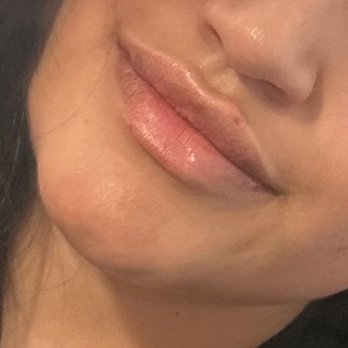 Lazer Lounge - After procedure - Laser Hair Removal Near Me - Studio City, California